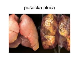 pušačka pluća
 