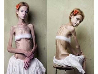 Desordenes alimentarios
ANOREXIA BULIMIA