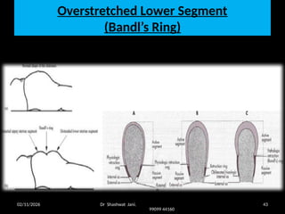 Jani Rind PROBLEM OF DELIVERING FETAL HEAD DURING CESAREAN SECTION BY DR SHASHWAT ...