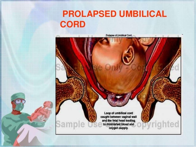 problems during labor and delivery 202 prolapsed cord