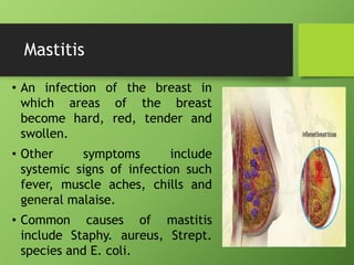 Mastitis
• An infection of the breast in
which areas of the breast
become hard, red, tender and
swollen.
• Other symptoms include
systemic signs of infection such
fever, muscle aches, chills and
general malaise.
• Common causes of mastitis
include Staphy. aureus, Strept.
species and E. coli.
 