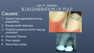 Failures in Fixed Partial Denture | PPTX