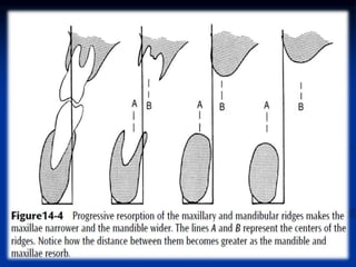 problems of residual alveolar ridge.ppt