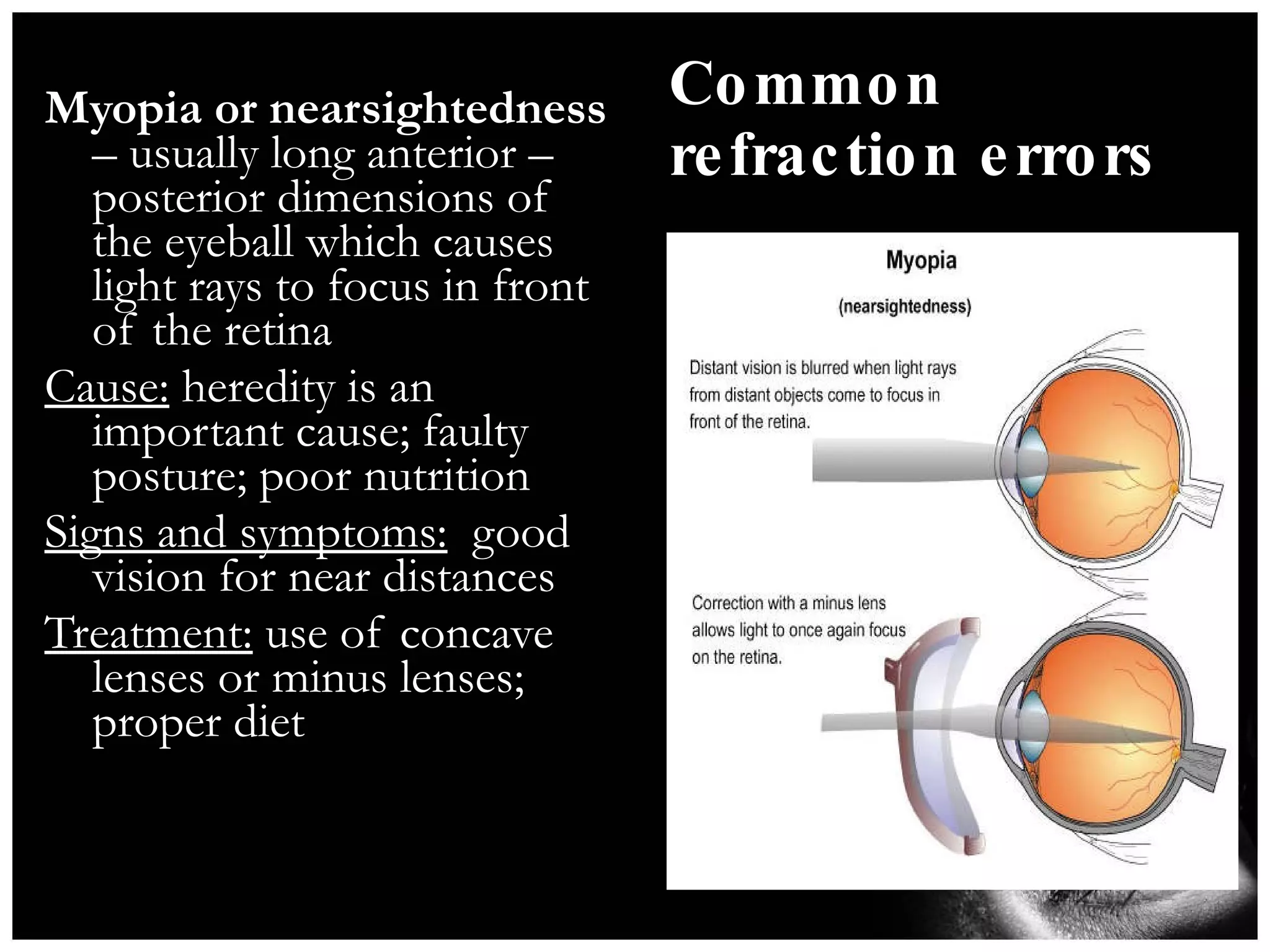 Common refraction errors Myopia or nearsightedness  – usually long anterior –posterior dimensions of the eyeball which causes light rays to focus in front of the retina Cause:  heredity is an important cause; faulty posture; poor nutrition Signs and symptoms:   good vision for near distances Treatment:  use of concave lenses or minus lenses; proper diet 