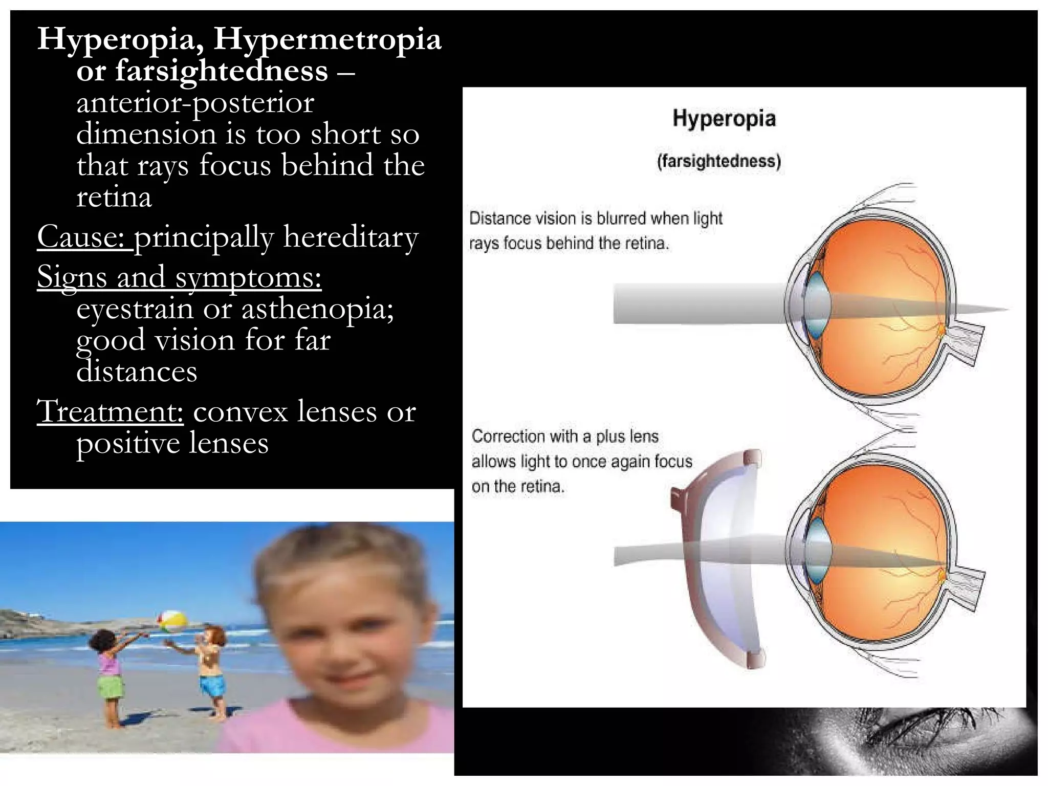 Hyperopia, Hypermetropia or farsightedness  – anterior-posterior dimension is too short so that rays focus behind the retina Cause:  principally hereditary Signs and symptoms:  eyestrain or asthenopia; good vision for far distances Treatment:  convex lenses or positive lenses 