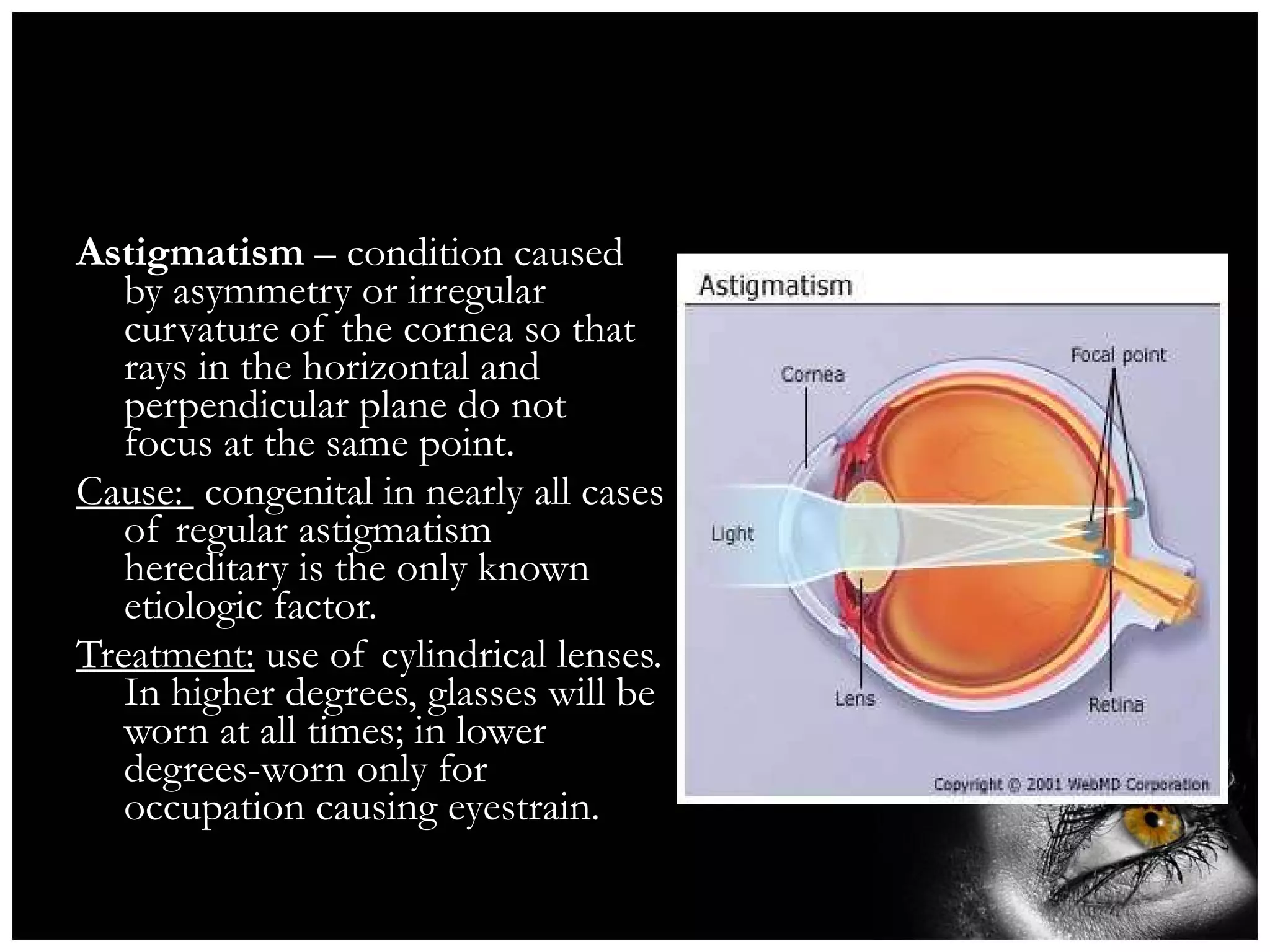 Astigmatism  – condition caused by asymmetry or irregular curvature of the cornea so that rays in the horizontal and perpendicular plane do not focus at the same point. Cause:  congenital in nearly all cases of regular astigmatism hereditary is the only known etiologic factor. Treatment:  use of cylindrical lenses. In higher degrees, glasses will be worn at all times; in lower degrees-worn only for occupation causing eyestrain.  