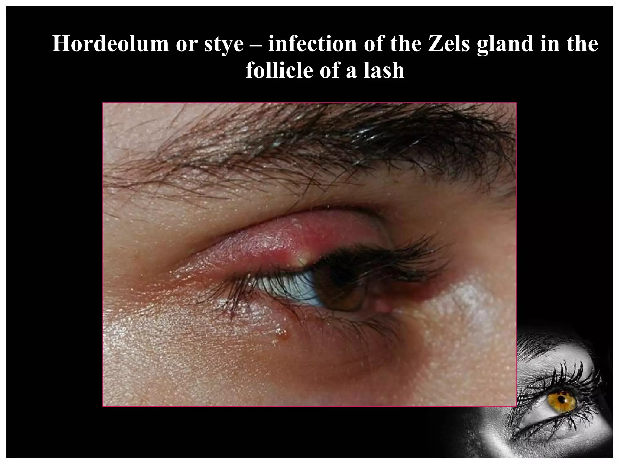 Hordeolum or stye – infection of the Zels gland in the follicle of a lash 