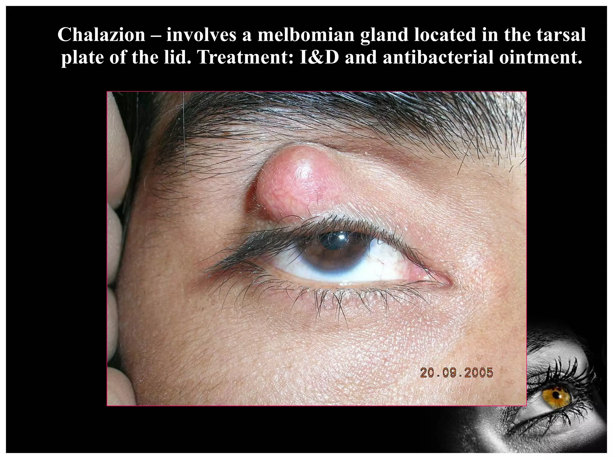 Chalazion – involves a melbomian gland located in the tarsal plate of the lid. Treatment: I&D and antibacterial ointment. 