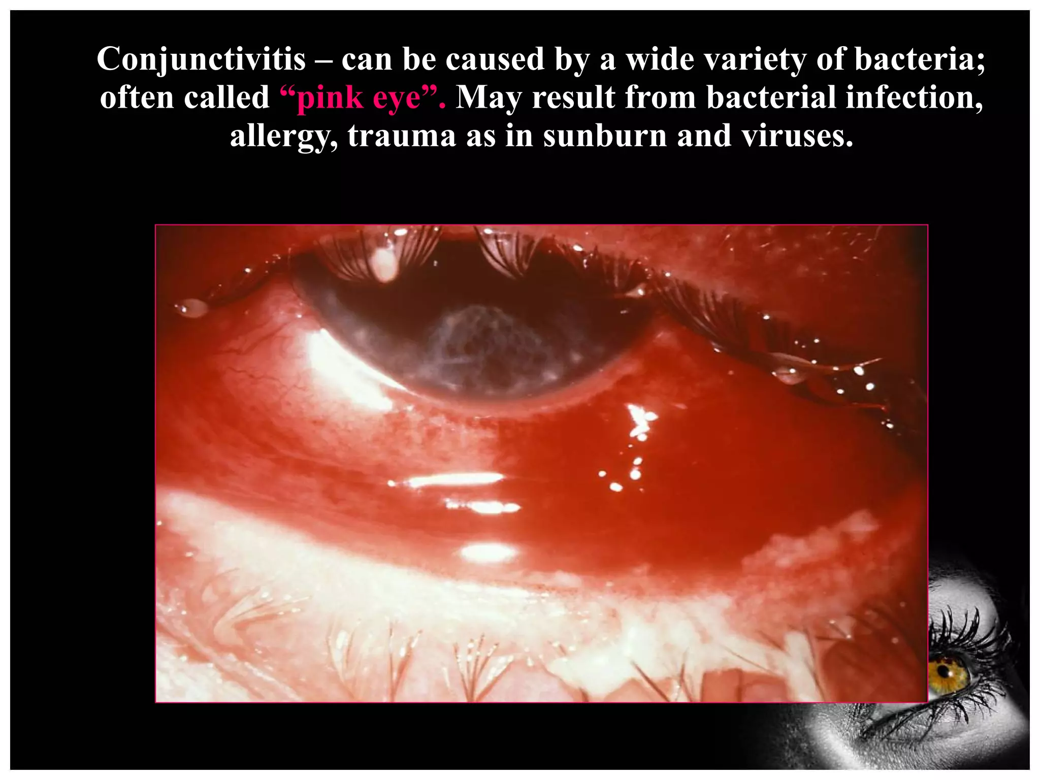 Conjunctivitis – can be caused by a wide variety of bacteria; often called  “pink eye”.  May result from bacterial infection, allergy, trauma as in sunburn and viruses. 