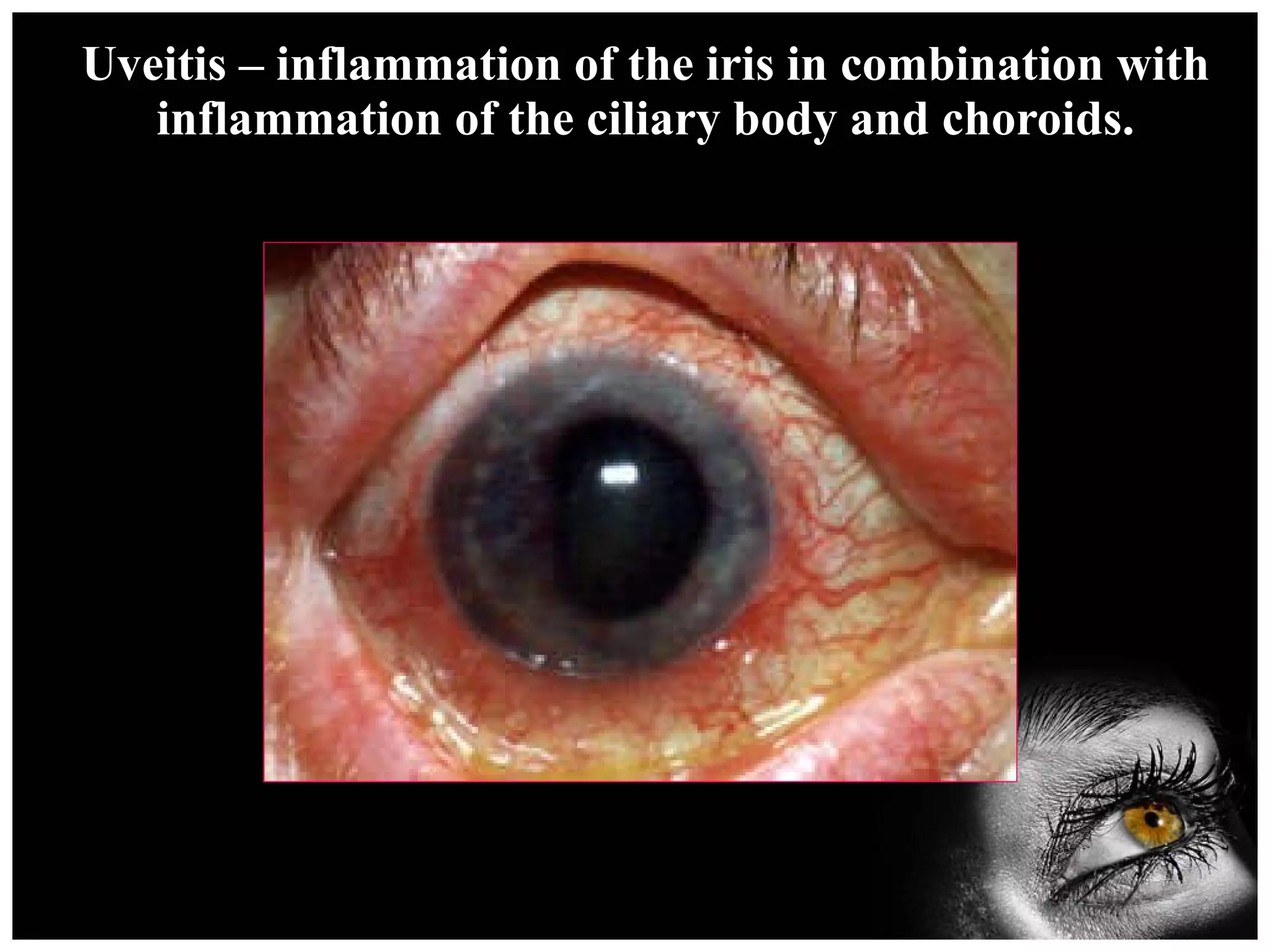 Uveitis – inflammation of the iris in combination with inflammation of the ciliary body and choroids. 