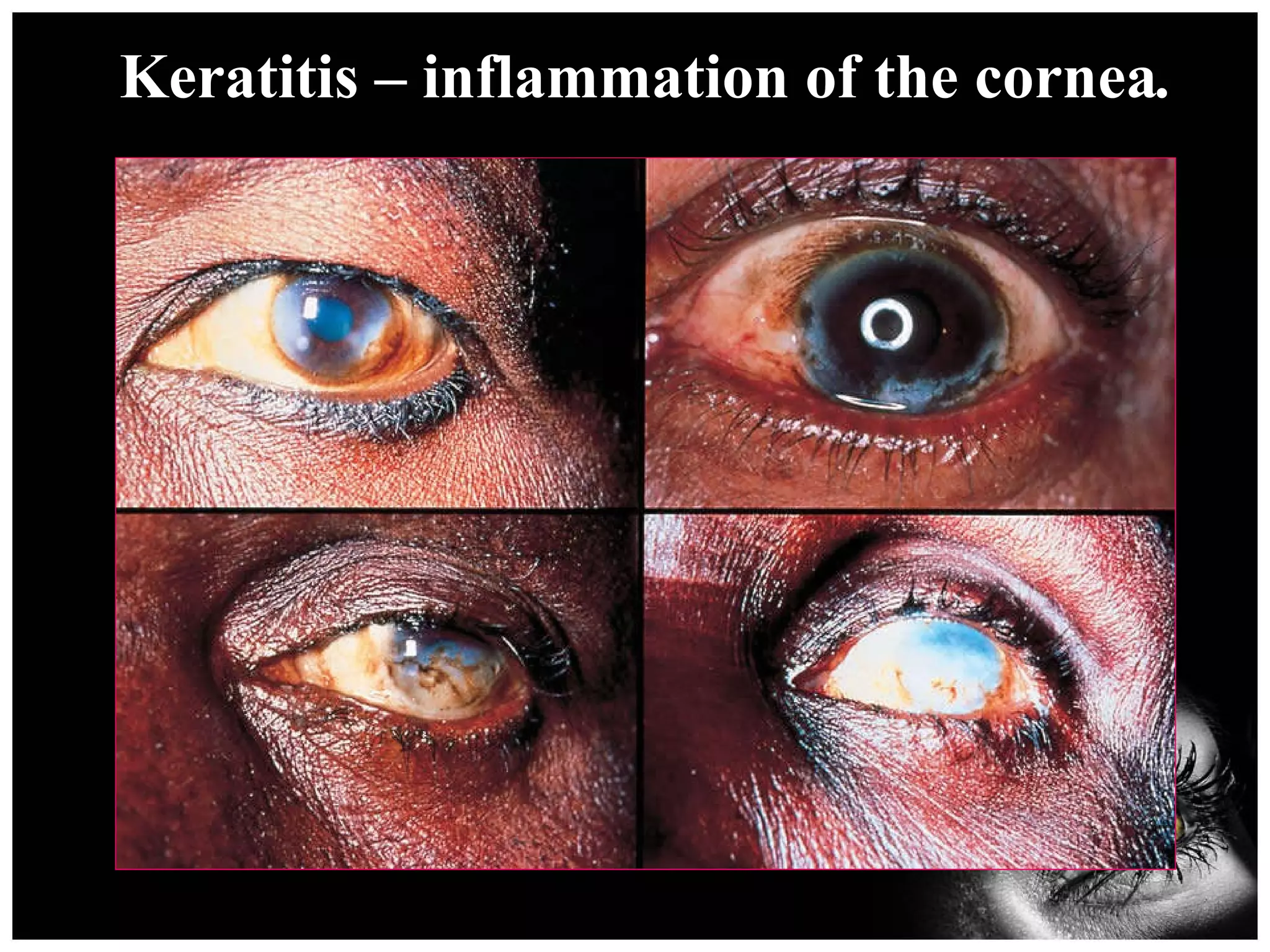 Keratitis – inflammation of the cornea . 