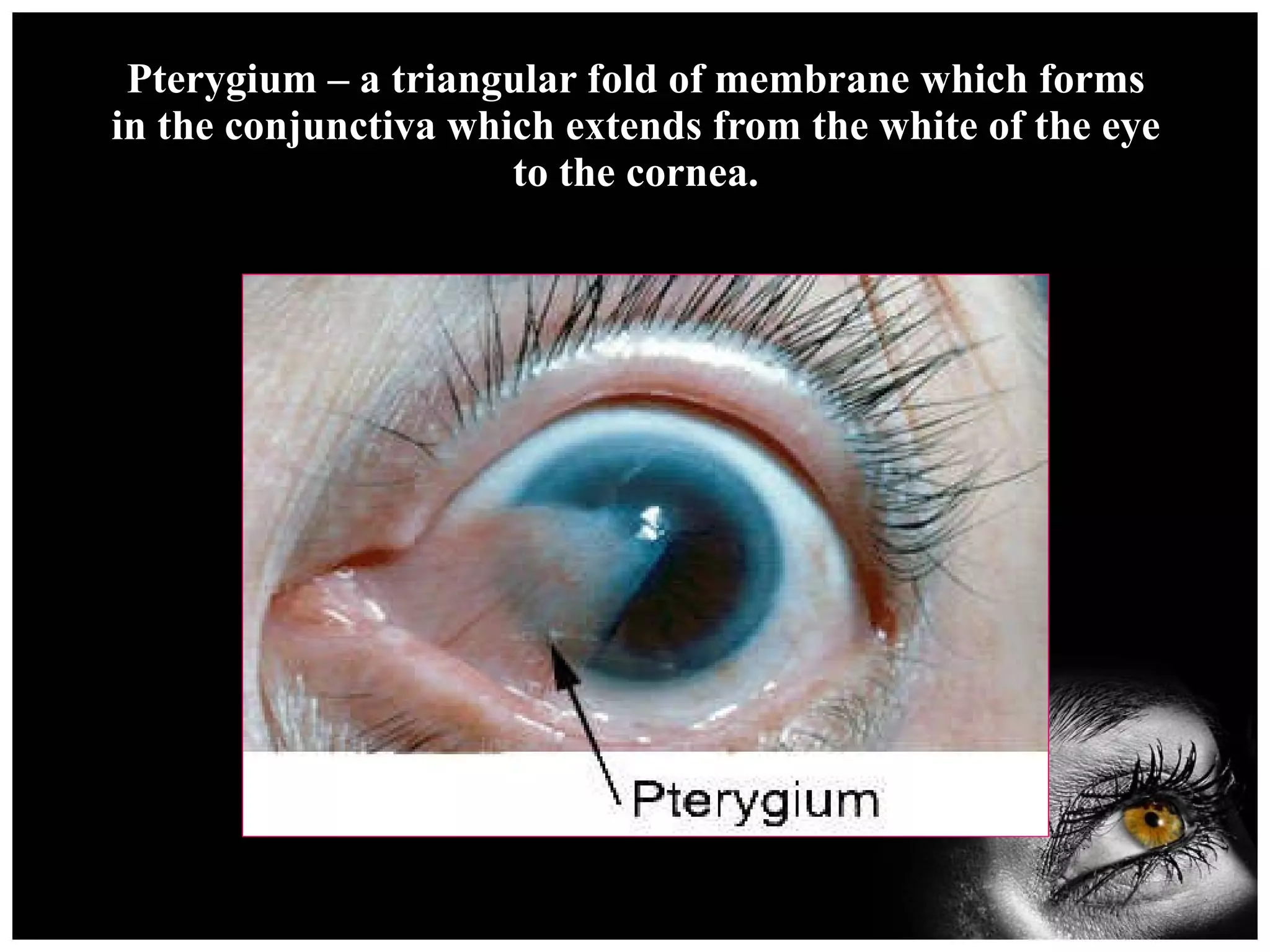 Pterygium – a triangular fold of membrane which forms in the conjunctiva which extends from the white of the eye to the cornea. 