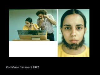 Facial hair transplant 1972
 