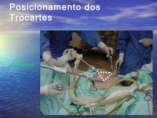 Posicionamento dos
Trocartes
• 1999 OR1

5 Portais

 