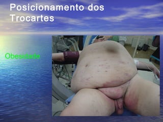 Posicionamento dos
Trocartes

Obesidade

 