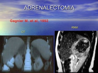 ADRENALECTOMIA
Gagnier M. et al, 1992
RNM
CT

 
