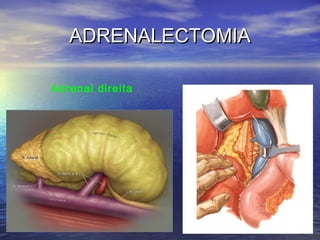 ADRENALECTOMIA
Adrenal direita

 