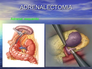 ADRENALECTOMIA
Adrenal esquerdo

 