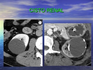 CISTO RENAL

 