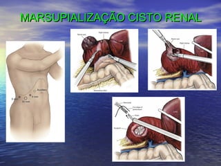 MARSUPIALIZAÇÃO CISTO RENAL

 