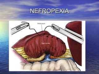 NEFROPEXIA

 