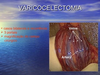 VARICOCELECTOMIA
 casos

bilaterais e recorrência
 3 portais
 magnificação do campo
cirúrgico

 