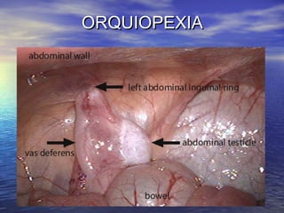 ORQUIOPEXIA

 