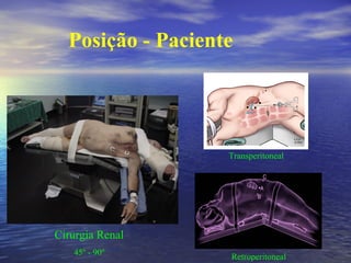 Posição - Paciente

Transperitoneal

Cirurgia Renal
45º - 90º

Retroperitoneal

 