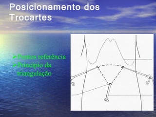 Posicionamento dos
Trocartes

Pontos referência
Princípio da
triangulação

 