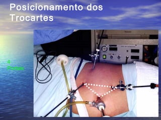 Posicionamento dos
Trocartes

4
Portais

 