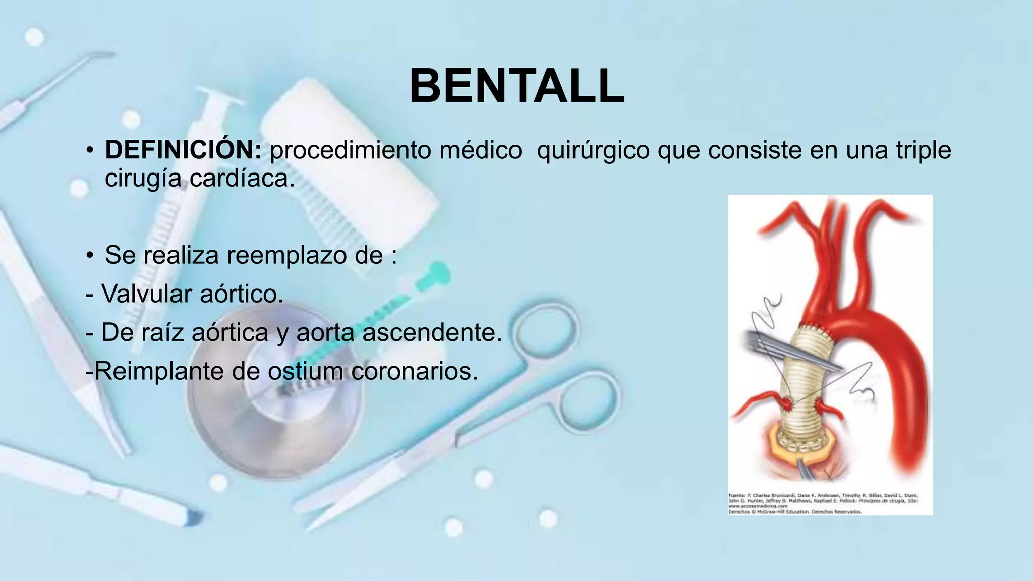 Procedimiento de bentall bono PPT