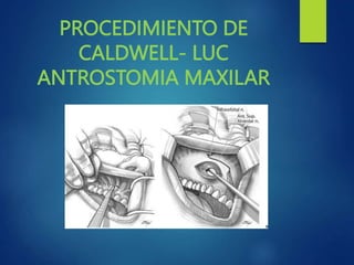 PROCEDIMIENTO DE
CALDWELL- LUC
ANTROSTOMIA MAXILAR
 
