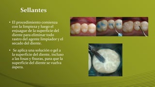 Sellantes
• El procedimiento comienza
con la limpieza y luego el
enjuague de la superficie del
diente para eliminar todo
rastro del agente limpiador y el
secado del diente.
• Se aplica una solución o gel a
la superficie del diente, incluso
a las fosas y fisuras, para que la
superficie del diente se vuelva
áspera.

 