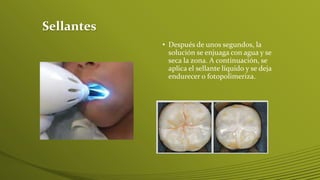 Sellantes
• Después de unos segundos, la
solución se enjuaga con agua y se
seca la zona. A continuación, se
aplica el sellante líquido y se deja
endurecer o fotopolimeriza.

 