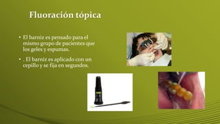 Fluoración tópica
• El barniz es pensado para el
mismo grupo de pacientes que
los geles y espumas.

• . El barniz es aplicado con un
cepillo y se fija en segundos.

 