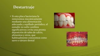 Destartraje
• Si esta placa bacteriana la
removemos mecánicamente
mediante una alimentación
adecuada y cepillado periódico, el
esmalte no sufre cambios
significativos y evita una pronta
deposición de sales de calcio,
alimentos y otros, que
habitualmente conocemos como
sarro o tártaro dental

 