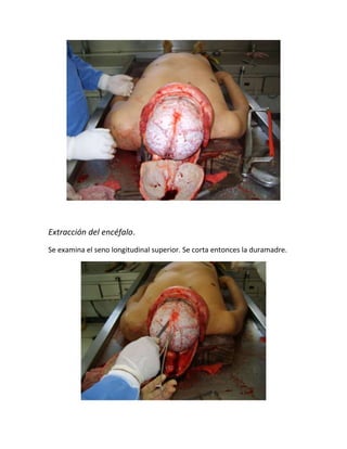 Extracción del encéfalo.
Se examina el seno longitudinal superior. Se corta entonces la duramadre.
 