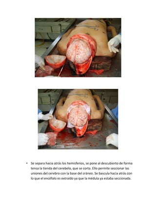 • Se separa hacia atrás los hemisferios, se pone al descubierto de forma
tensa la tienda del cerebelo, que se corta. Ello permite seccionar las
uniones del cerebro con la base del cráneo. Se bascula hacia atrás con
lo que el encéfalo es extraído ya que la médula ya estaba seccionada.
 