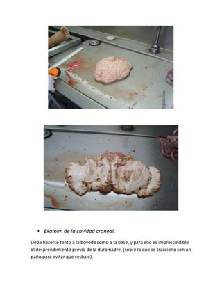 • Examen de la cavidad craneal.
Deba hacerse tanto a la bóveda como a la base, y para ello es imprescindible
el desprendimiento previo de la duramadre, (sobre la que se tracciona con un
paño para evitar que resbale).
 