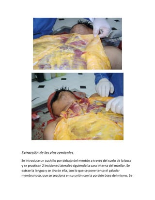 Extracción de las vías cervicales.
Se introduce un cuchillo por debajo del mentón a través del suelo de la boca
y se practican 2 incisiones laterales siguiendo la cara interna del maxilar. Se
extrae la lengua y se tira de ella, con lo que se pone tenso el paladar
membranoso, que se secciona en su unión con la porción ósea del mismo. Se
 