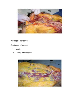 Necropsia del tórax:
Incisiones cutáneas:
• Media
• En peto o forma de U
 