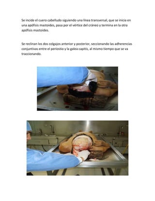 Se incide el cuero cabelludo siguiendo una línea transversal, que se inicia en
una apófisis mastoides, pasa por el vértice del cráneo y termina en la otra
apófisis mastoides.
Se reclinan los dos colgajos anterior y posterior, seccionando las adherencias
conjuntivas entre el periostio y la galea capitis, al mismo tiempo que se va
traccionando.
 