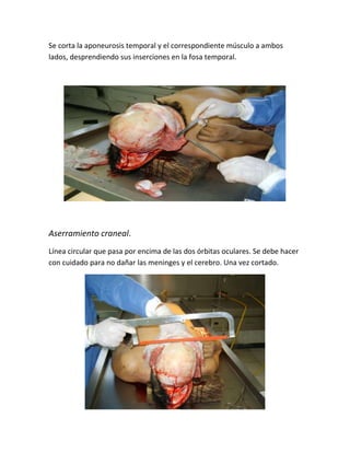 Se corta la aponeurosis temporal y el correspondiente músculo a ambos
lados, desprendiendo sus inserciones en la fosa temporal.
Aserramiento craneal.
Línea circular que pasa por encima de las dos órbitas oculares. Se debe hacer
con cuidado para no dañar las meninges y el cerebro. Una vez cortado.
 