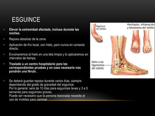 ESGUINCE
•   Elevar la extremidad afectada, incluso durante las
    noches.
•   Reposo absoluto de la zona.
•   Aplicación de frío local, con hielo, pero nunca en contacto
    directo.
•   Envolveremos el hielo en una tela limpia y lo aplicaremos en
    intervalos de tiempo.
•   Traslado a un centro hospitalario para las
    correspondientes pruebas y en caso necesario nos
    pondrán una férula .

•   Se deberá guardar reposo durante varios días, siempre
    dependiendo del grado de gravedad del esguince.
    Por lo general, será de 10 días para esguinces leves y 3 a 5
    semanas para esguinces graves.
    Puede ser necesario que la persona lesionada necesite el
    uso de muletas para caminar.
 