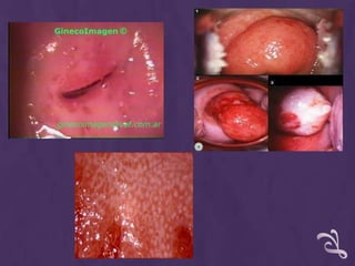 BIOPSIA TRANSOPERATORIA Se realiza durante la intervención quirúrgica, cuando se requiere para definir una conducta o estadificar una neoplasia.Dos tipos de biopsia:Incisional. Comprende la remoción de una parte representativa de la lesión, que contenga también tejido sano para su comparación. Se realiza si la lesión es lo suficientemente grande como para retirarla por completo.Excisional. Realiza una toma de muestra, que comprende un margen de tejido normal alrededor de todos sus bordes y retira la lesión de forma completa.Las muestras se envían a patología fijadas en formol al 10%.