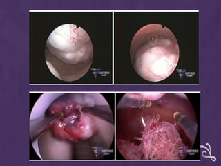  Localización de la unión escamocolumnar.