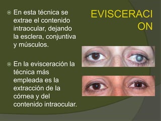 EVISCERACI
ON
 En esta técnica se
extrae el contenido
intraocular, dejando
la esclera, conjuntiva
y músculos.
 En la evisceración la
técnica más
empleada es la
extracción de la
córnea y del
contenido intraocular.
 