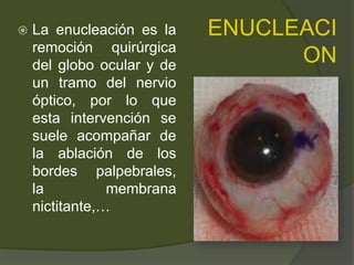 ENUCLEACI
ON
 La enucleación es la
remoción quirúrgica
del globo ocular y de
un tramo del nervio
óptico, por lo que
esta intervención se
suele acompañar de
la ablación de los
bordes palpebrales,
la membrana
nictitante,…
 
