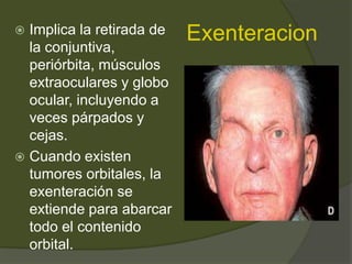 Exenteracion Implica la retirada de
la conjuntiva,
periórbita, músculos
extraoculares y globo
ocular, incluyendo a
veces párpados y
cejas.
 Cuando existen
tumores orbitales, la
exenteración se
extiende para abarcar
todo el contenido
orbital.
 