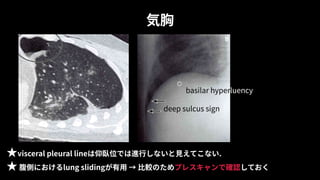 気胸
★visceral pleural lineは仰臥位では進⾏しないと⾒えてこない.
★ 腹側におけるlung slidingが有⽤ → ⽐較のためプレスキャンで確認しておく
deep sulcus sign
basilar hyperluency
 